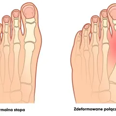 Haluksy? Poznaj 5 kroków do zdrowych stóp!