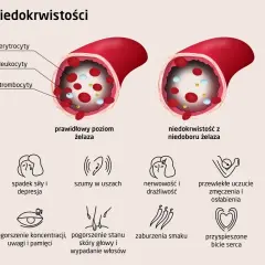 Czy masz niedobór żelaza? Objawy, badania, interpretacja wyników