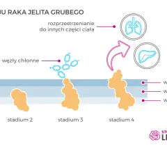Rak jelita grubego: rokowania. Jak zmienić statystyki na swoją korzyść?