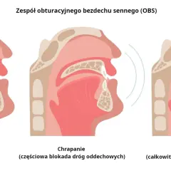 Chrapanie: Jak odzyskać cichy sen? Domowe triki i leczenie OBS.