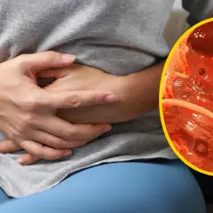 Nie lekceważ bólu brzucha! Rak jelita grubego: objawy i co robić?