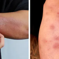 Objawy skórne raka jelita grubego: Kiedy iść do lekarza?