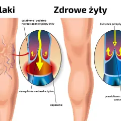Żylaki: jak im zapobiec? Odkryj sekrety lekkich nóg!