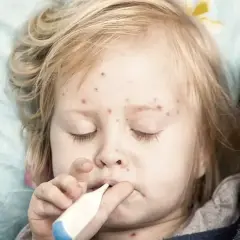 Dziecko z ospą wietrzną i termometrem w ustach.