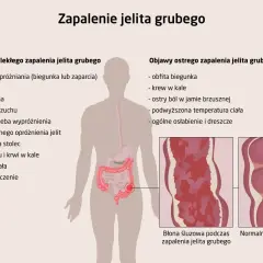 Objawy chorób jelit: Rozpoznaj sygnały alarmowe i działaj!