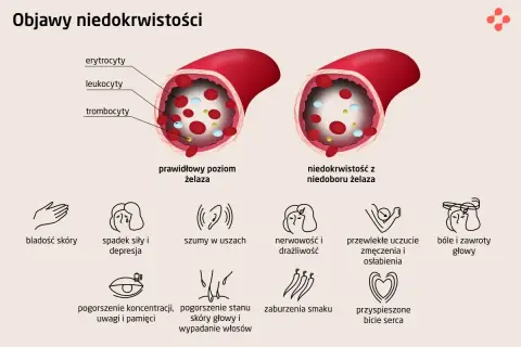 Czy masz niedobór żelaza? Objawy, badania, interpretacja wyników