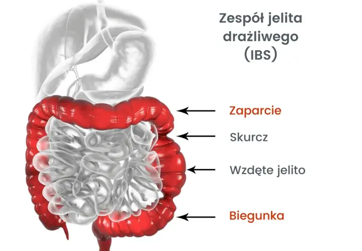 ZJD: Czy to zespół jelita drażliwego? Objawy, diagnostyka, leczenie
