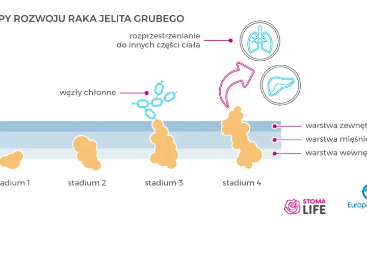 Rak jelita grubego: rokowania. Jak zmienić statystyki na swoją korzyść?