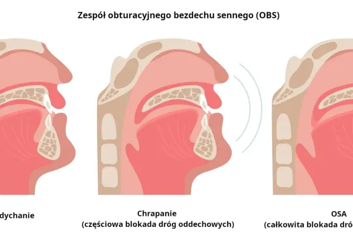 Chrapanie: Jak odzyskać cichy sen? Domowe triki i leczenie OBS.