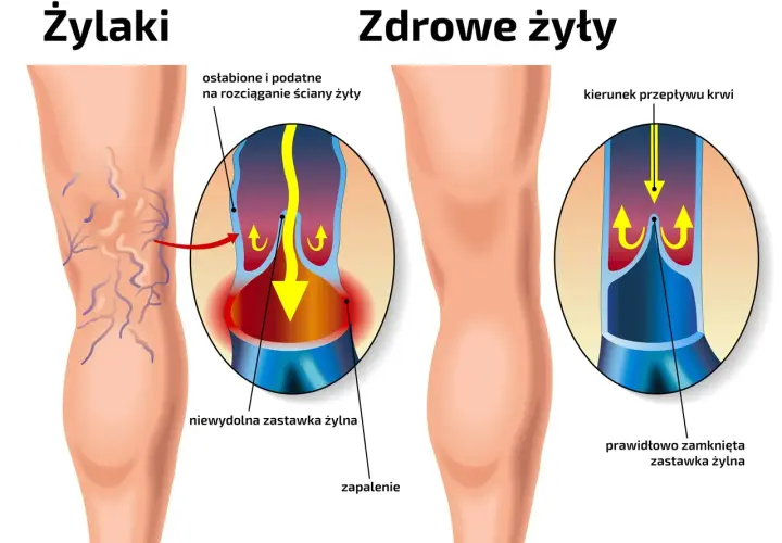 Żylaki: jak im zapobiec? Odkryj sekrety lekkich nóg!