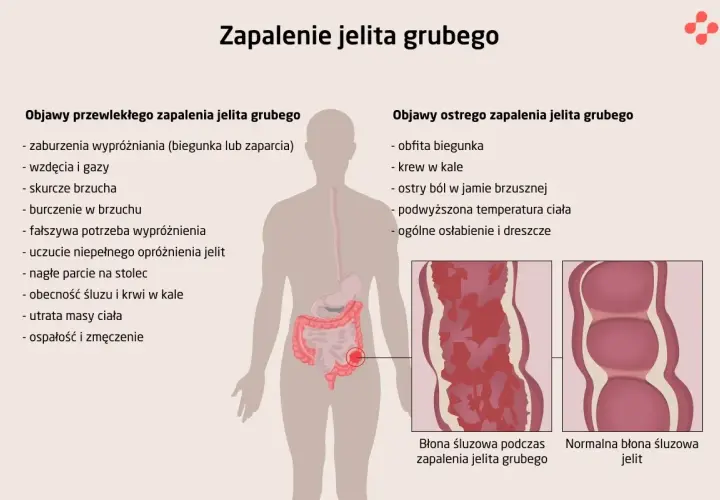 Objawy chorób jelit: Rozpoznaj sygnały alarmowe i działaj!
