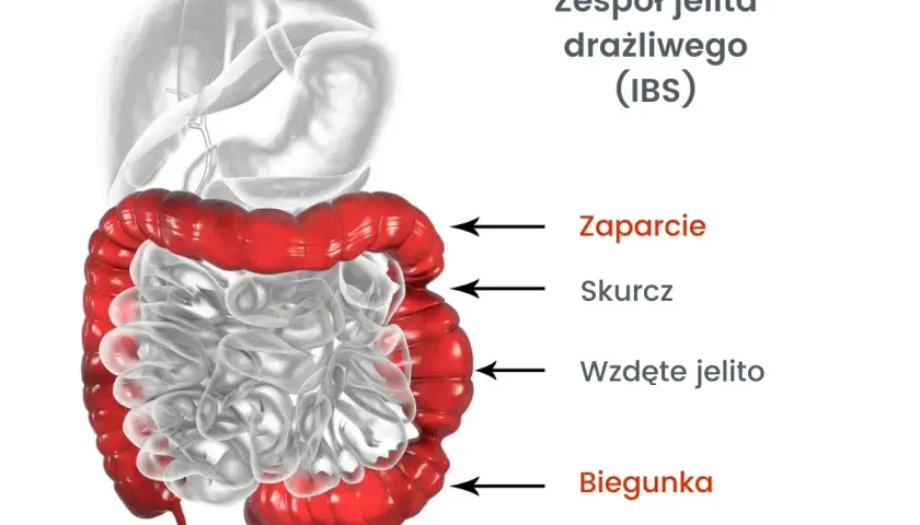 ZJD: Czy to zespół jelita drażliwego? Objawy, diagnostyka, leczenie