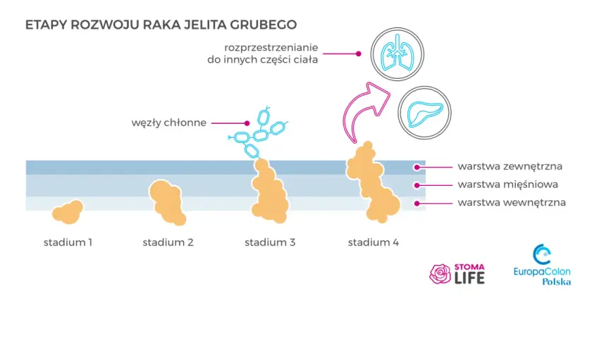 Rak jelita grubego: rokowania. Jak zmienić statystyki na swoją korzyść?