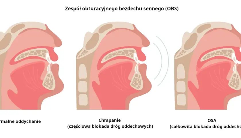 Chrapanie: Jak odzyskać cichy sen? Domowe triki i leczenie OBS.