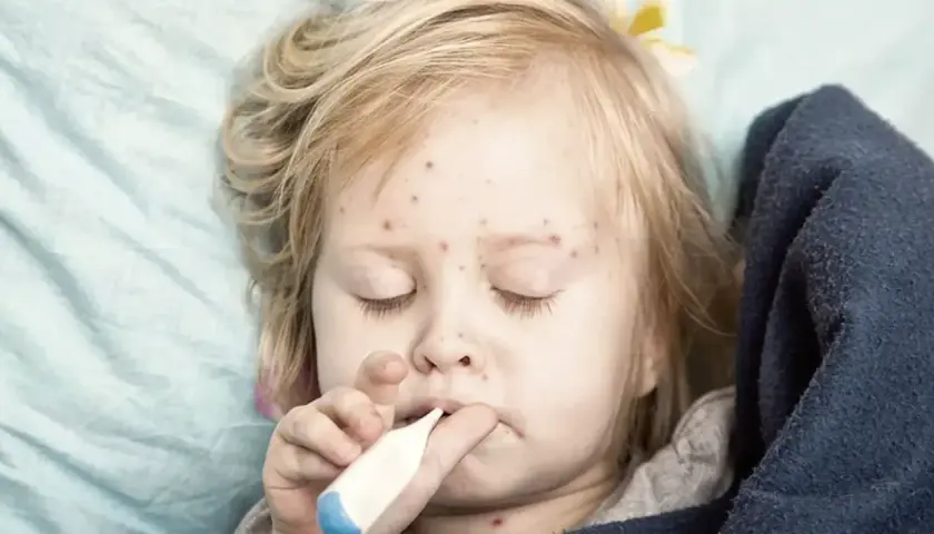 Dziecko z ospą wietrzną i termometrem w ustach.