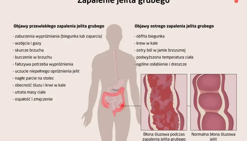 Objawy chorób jelit: Rozpoznaj sygnały alarmowe i działaj!
