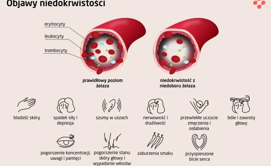 Czy masz niedobór żelaza? Objawy, badania, interpretacja wyników