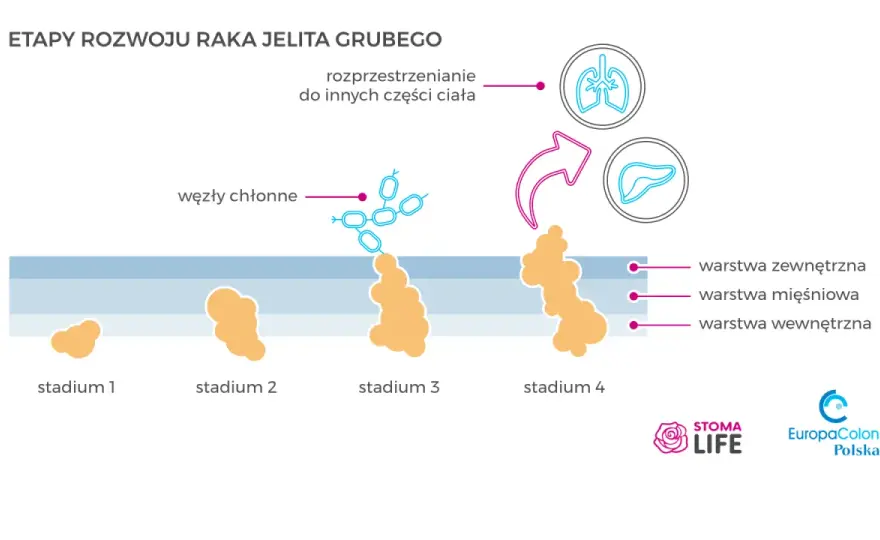 Rak jelita grubego: rokowania. Jak zmienić statystyki na swoją korzyść?