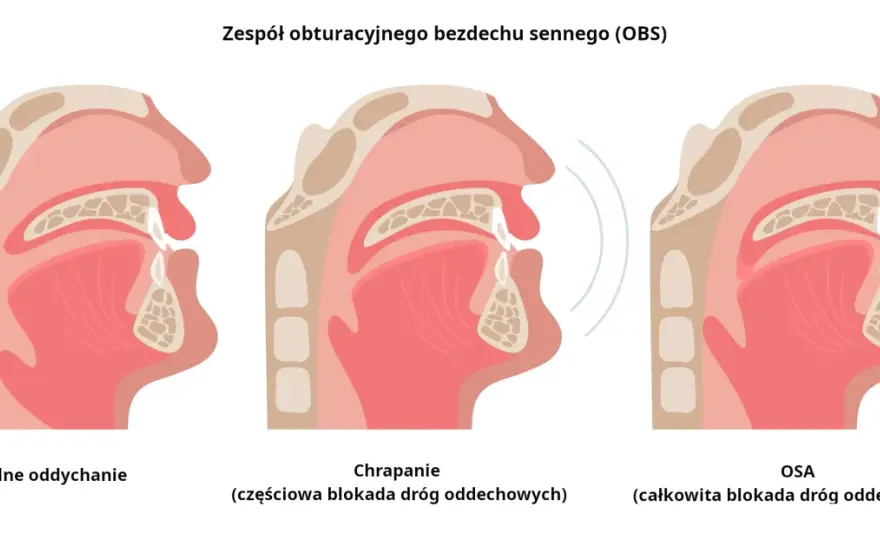 Chrapanie: Jak odzyskać cichy sen? Domowe triki i leczenie OBS.