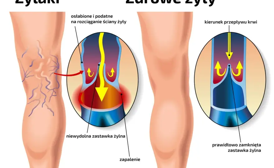 Żylaki: jak im zapobiec? Odkryj sekrety lekkich nóg!