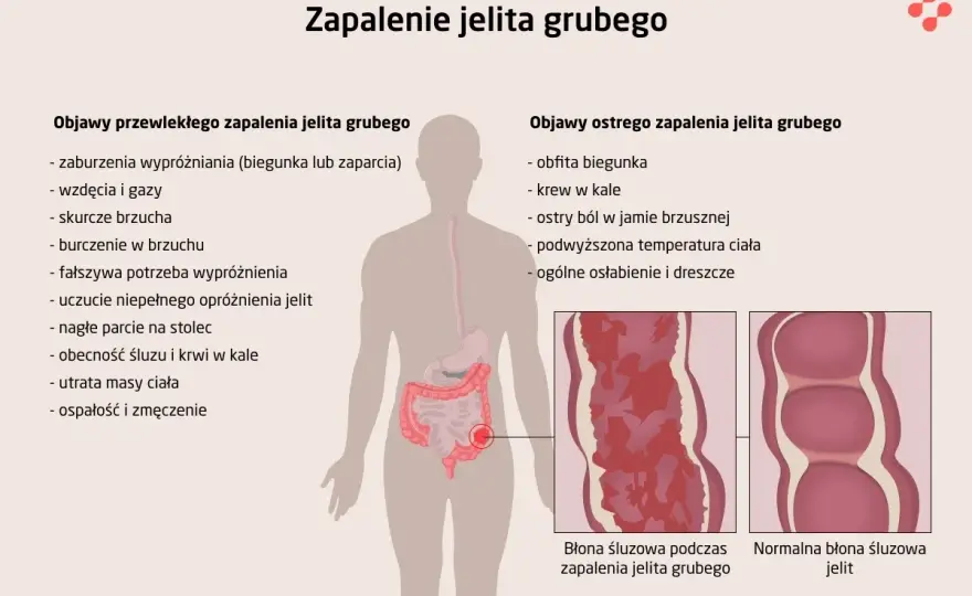 Objawy chorób jelit: Rozpoznaj sygnały alarmowe i działaj!