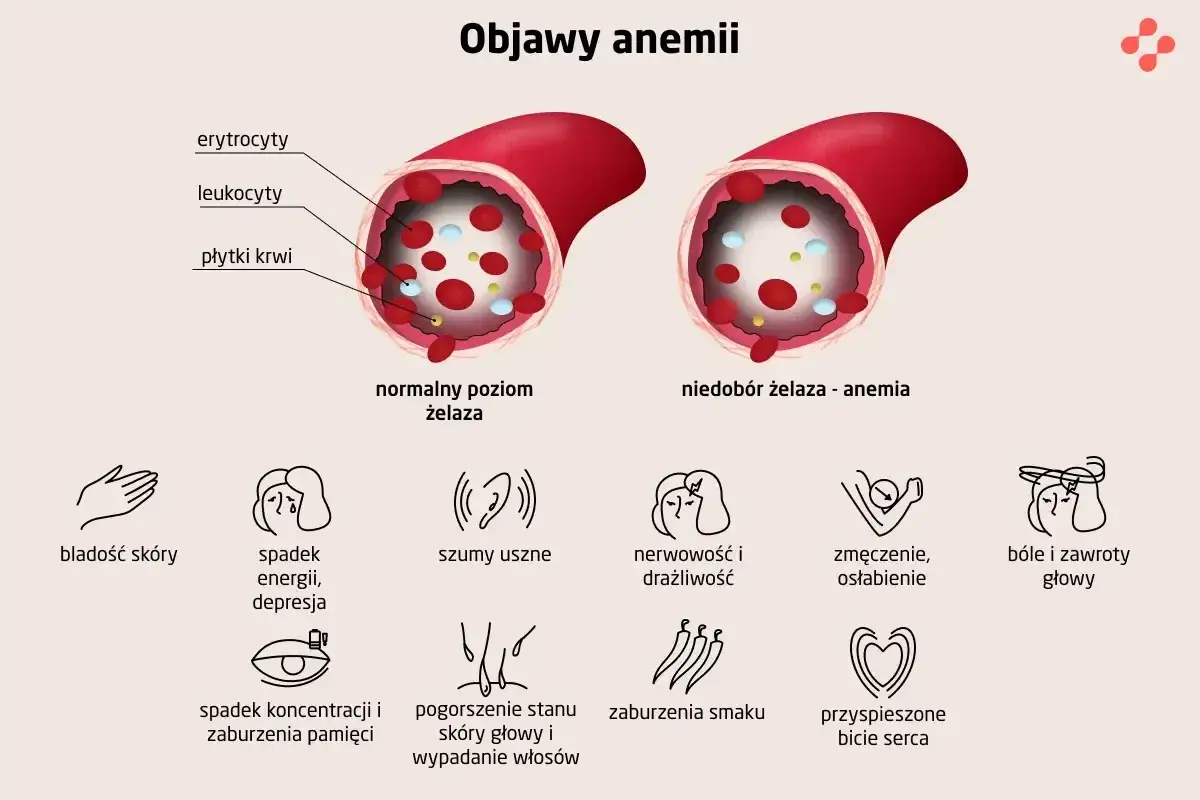 Objawy niedoboru żelaza zmęczenie blada skóra