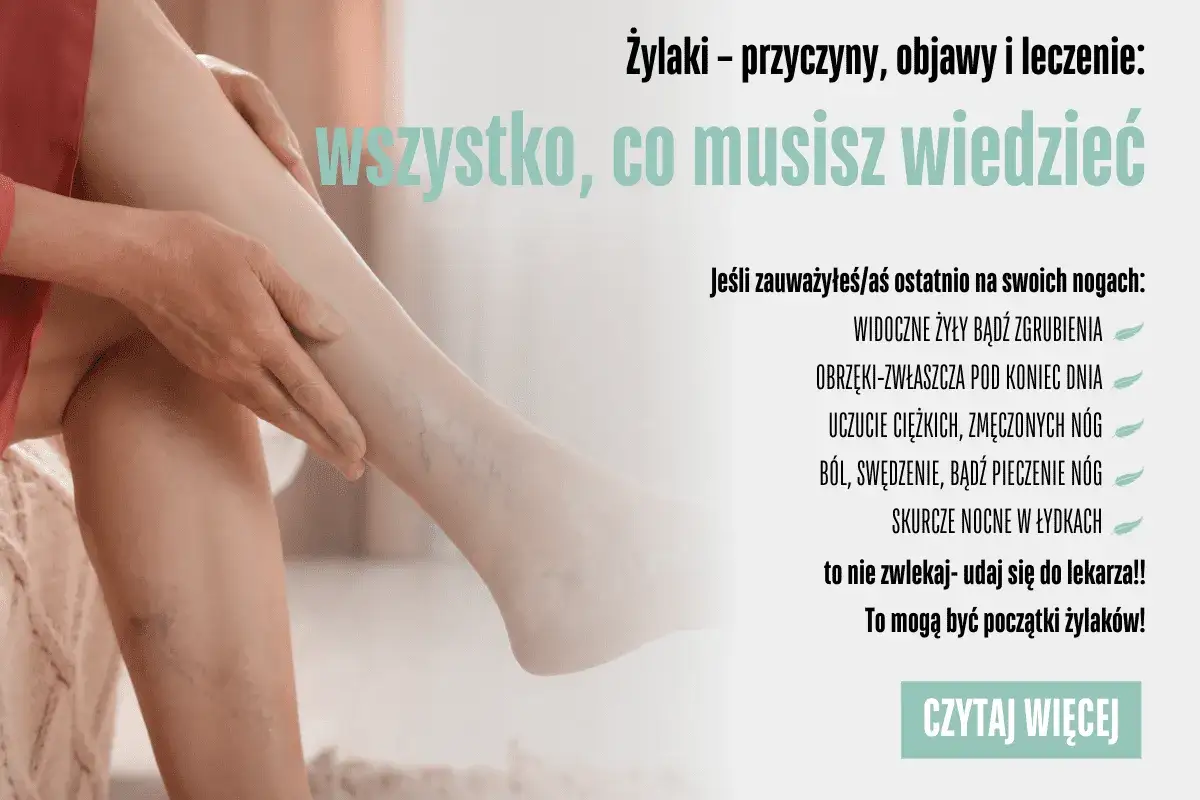 Aktywność fizyczna a żylaki