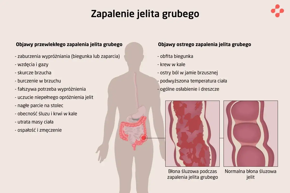 Zapalenie jelit ogólne informacje